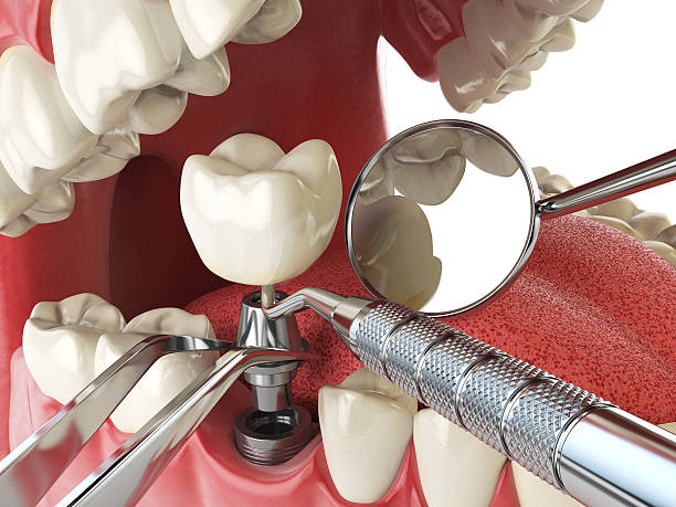 Best Emergency Dental Care for Broken or Chipped Teeth in San Saba, TX