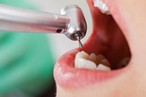 Best Emergency Treatment for Dental Infections or Abscesses in San Saba, TX